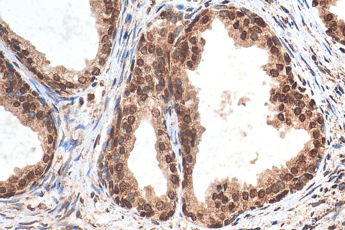 Immunohistochemistry (IHC) staining of human prostate cancer tissue using HMGA1 Polyclonal antibody (29895-1-AP)