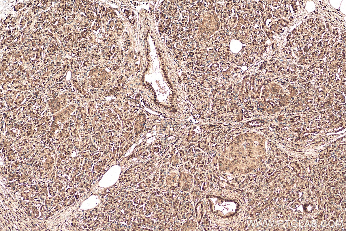 IHC staining of human pancreas cancer using 29895-1-AP