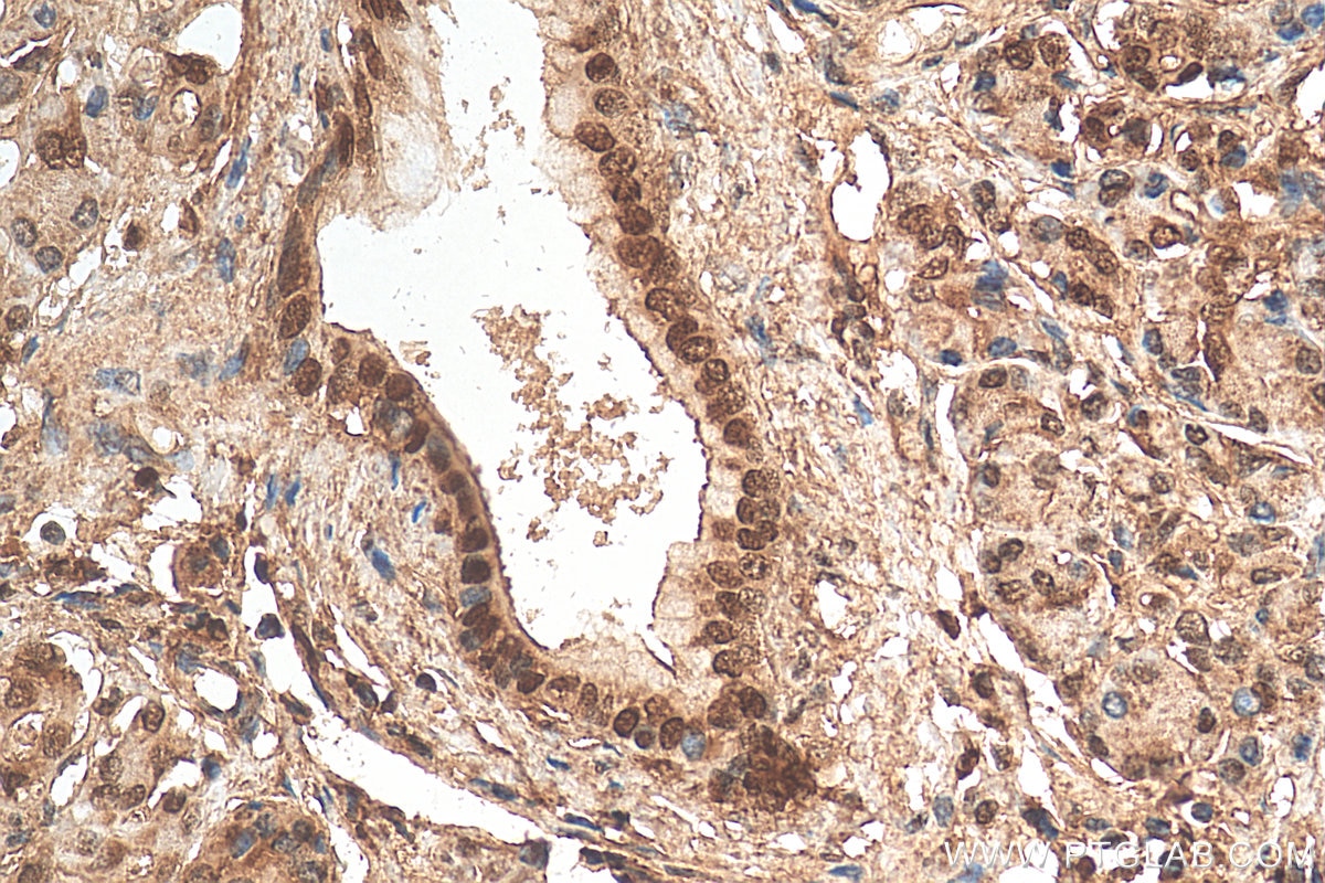 Immunohistochemistry (IHC) staining of human pancreas cancer tissue using HMGA1 Polyclonal antibody (29895-1-AP)