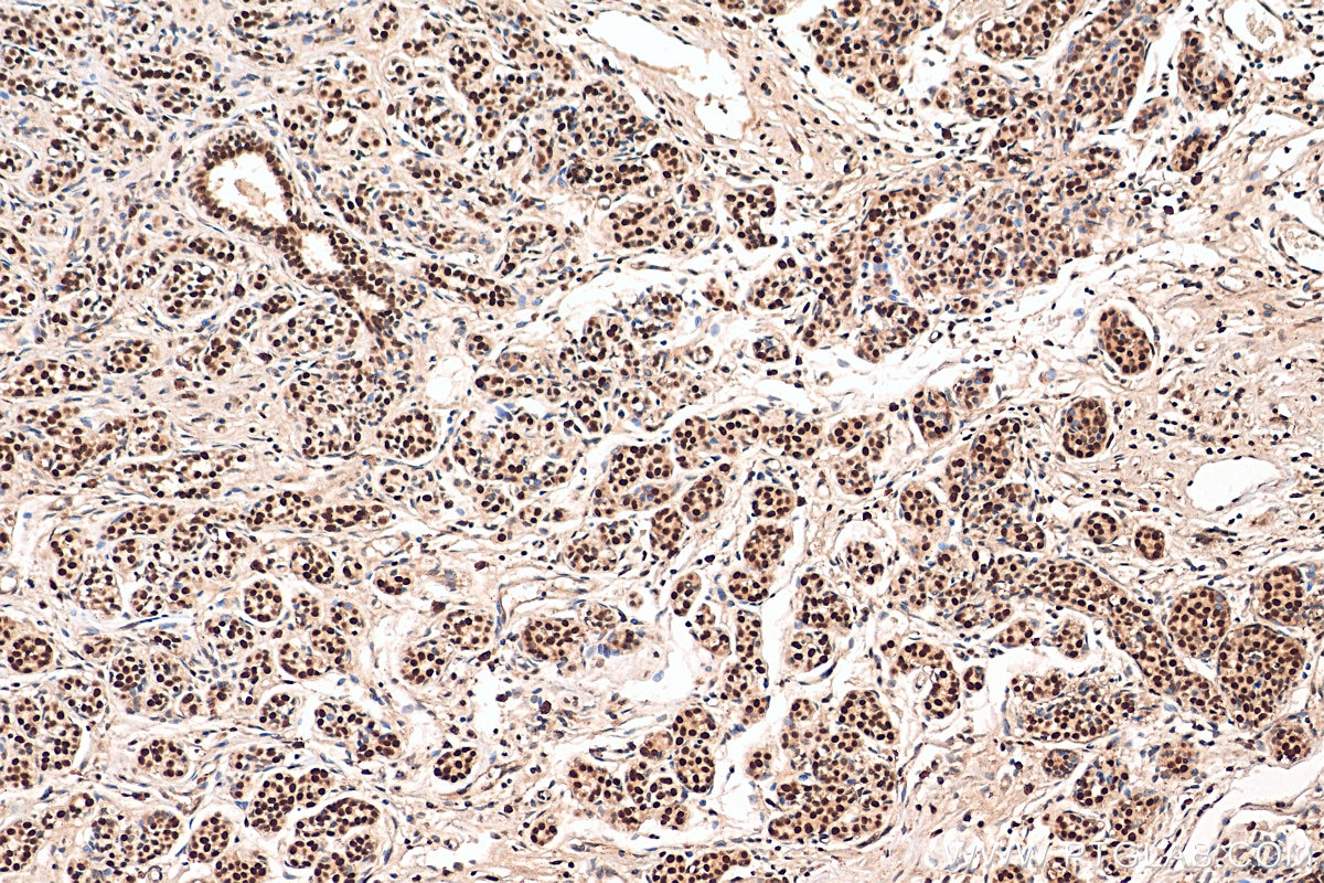 Immunohistochemistry (IHC) staining of human breast cancer tissue using HMGA1 Polyclonal antibody (29895-1-AP)