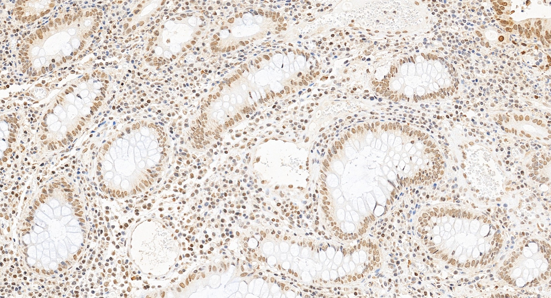 Immunohistochemistry (IHC) staining of human colon cancer tissue using HMGA2 Polyclonal antibody (20795-1-AP)