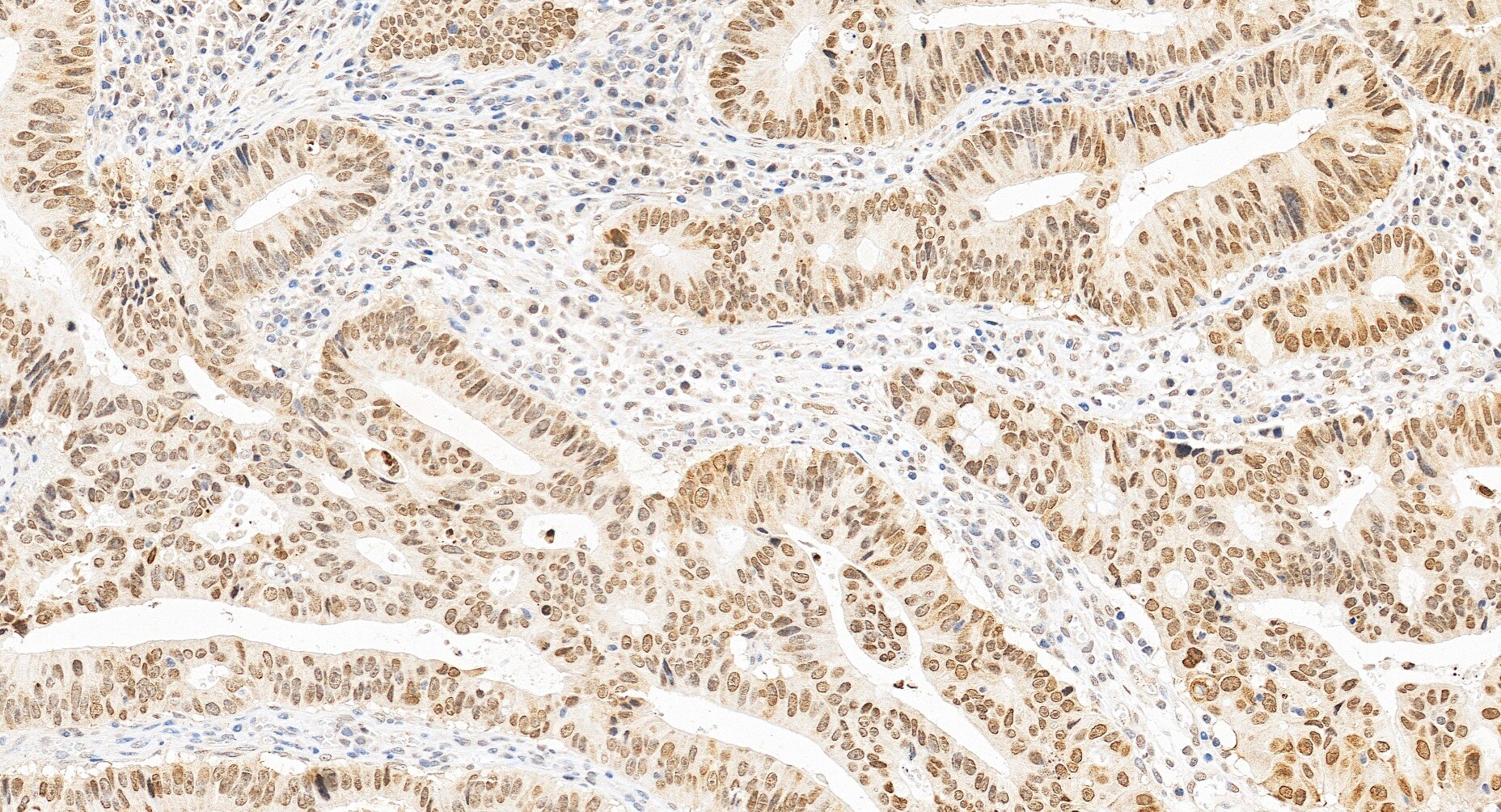 Immunohistochemistry (IHC) staining of human colon cancer tissue using HMGA2 Polyclonal antibody (20795-1-AP)