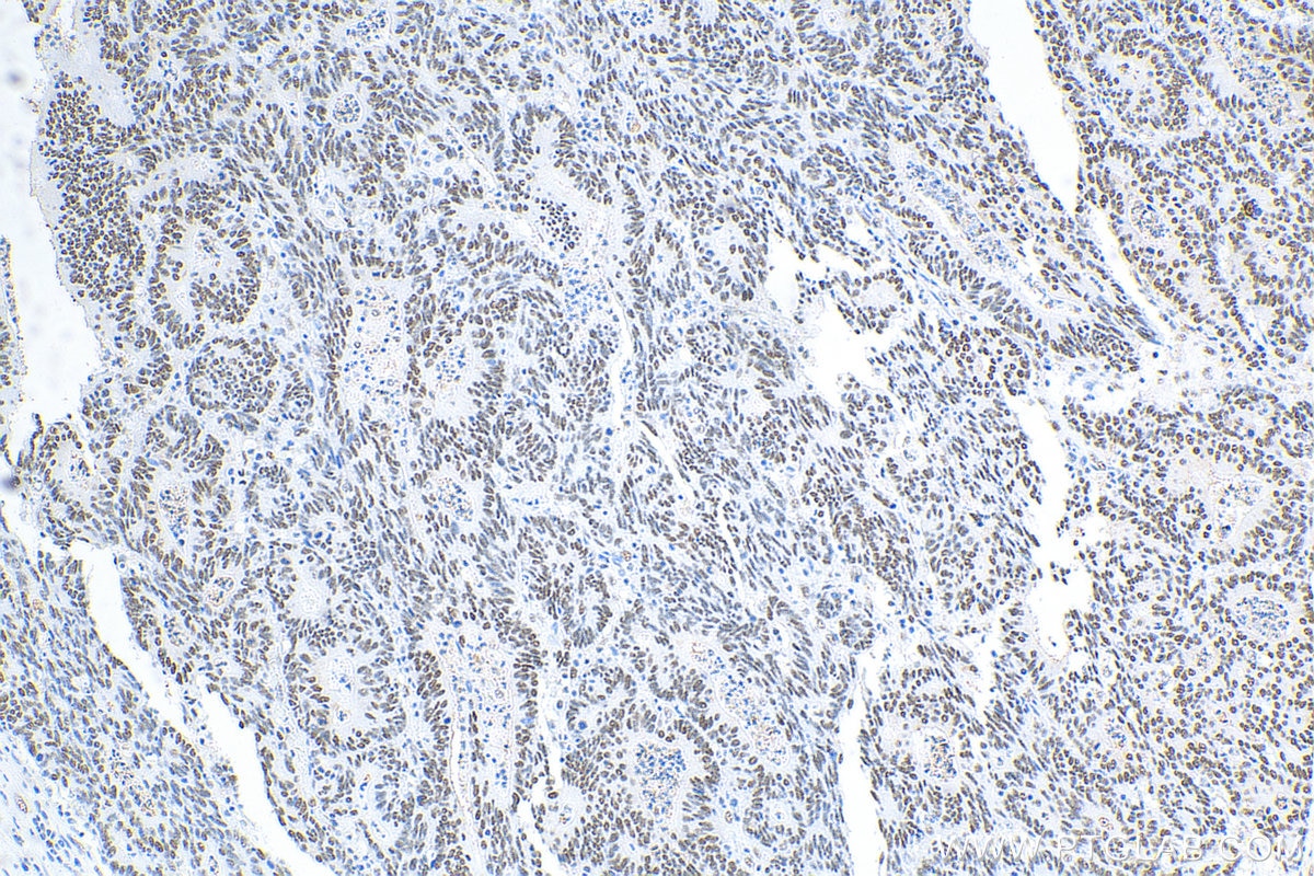 IHC staining of human colon cancer using 20795-1-AP