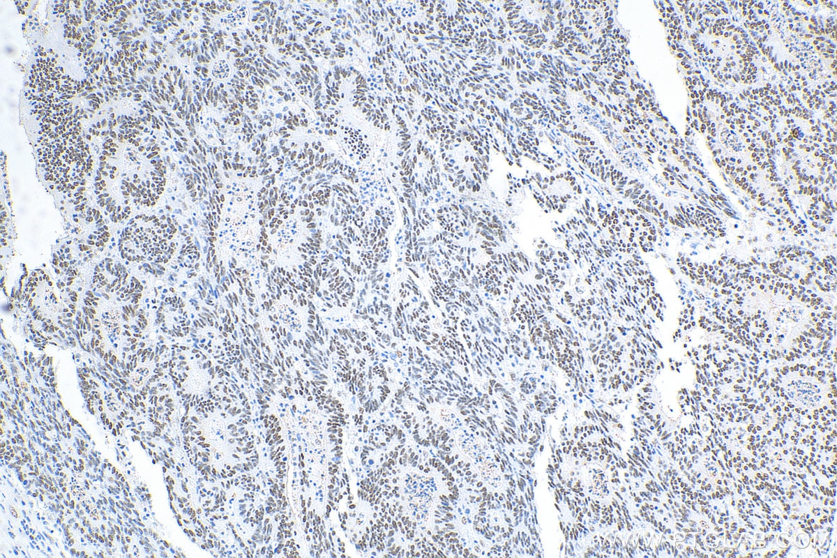 Immunohistochemistry (IHC) staining of human colon cancer tissue using HMGA2 Polyclonal antibody (20795-1-AP)