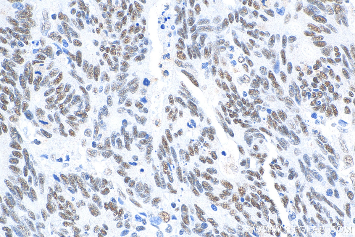Immunohistochemistry (IHC) staining of human colon cancer tissue using HMGA2 Polyclonal antibody (20795-1-AP)