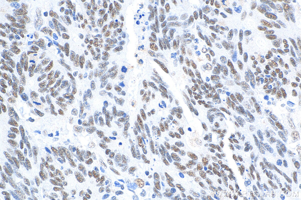 IHC staining of human colon cancer using 20795-1-AP