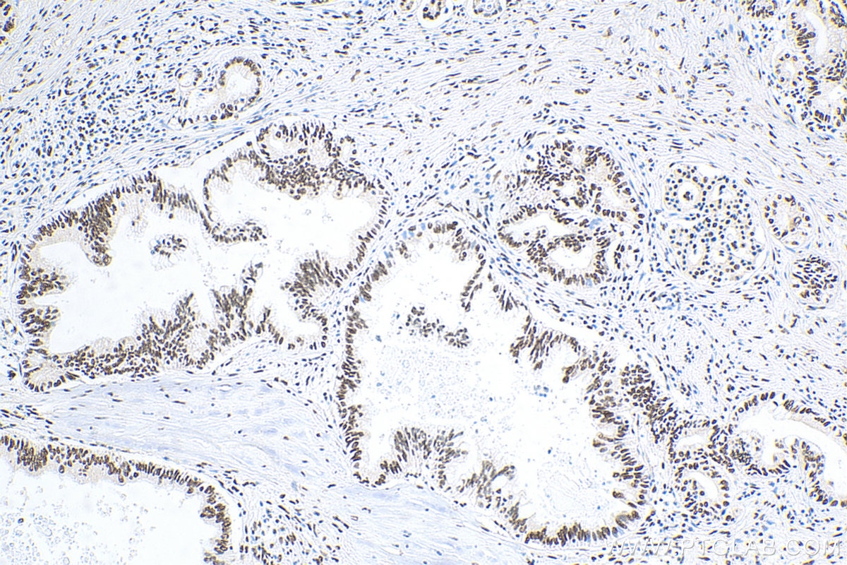 Immunohistochemistry (IHC) staining of human pancreas cancer tissue using HMGA2 Polyclonal antibody (20795-1-AP)