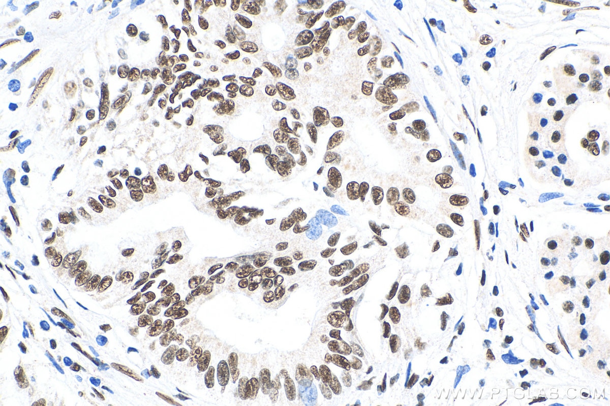 Immunohistochemistry (IHC) staining of human pancreas cancer tissue using HMGA2 Polyclonal antibody (20795-1-AP)
