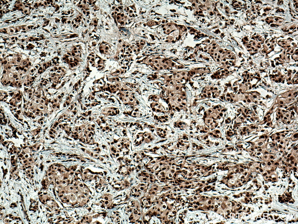 Immunohistochemistry (IHC) staining of human breast cancer tissue using HMGB1 Polyclonal antibody (10829-1-AP)