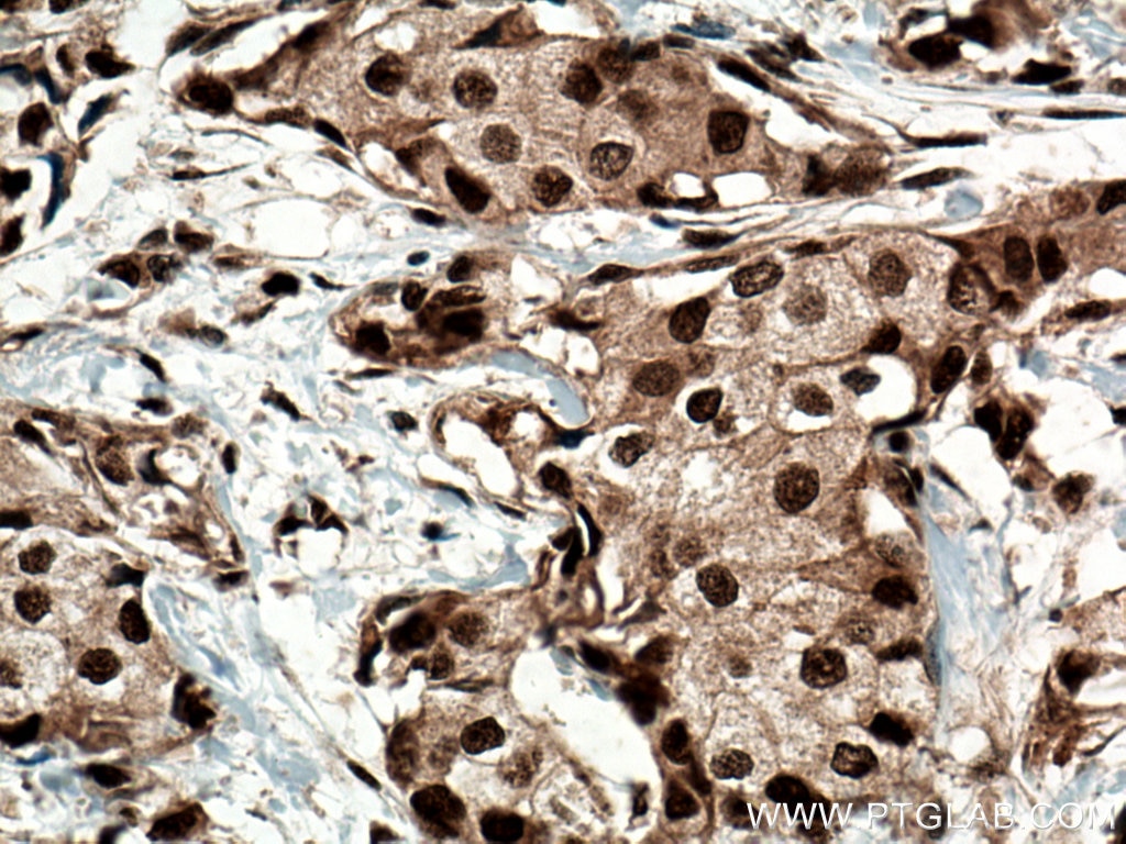 Immunohistochemistry (IHC) staining of human breast cancer tissue using HMGB1 Polyclonal antibody (10829-1-AP)
