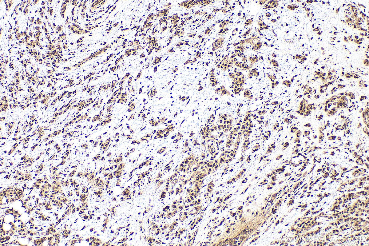 IHC staining of human breast cancer using 10829-1-AP Immunohistochemistry (IHC) staining of human breast cancer tissue using HMGB1 Polyclonal antibody (10829-1-AP)