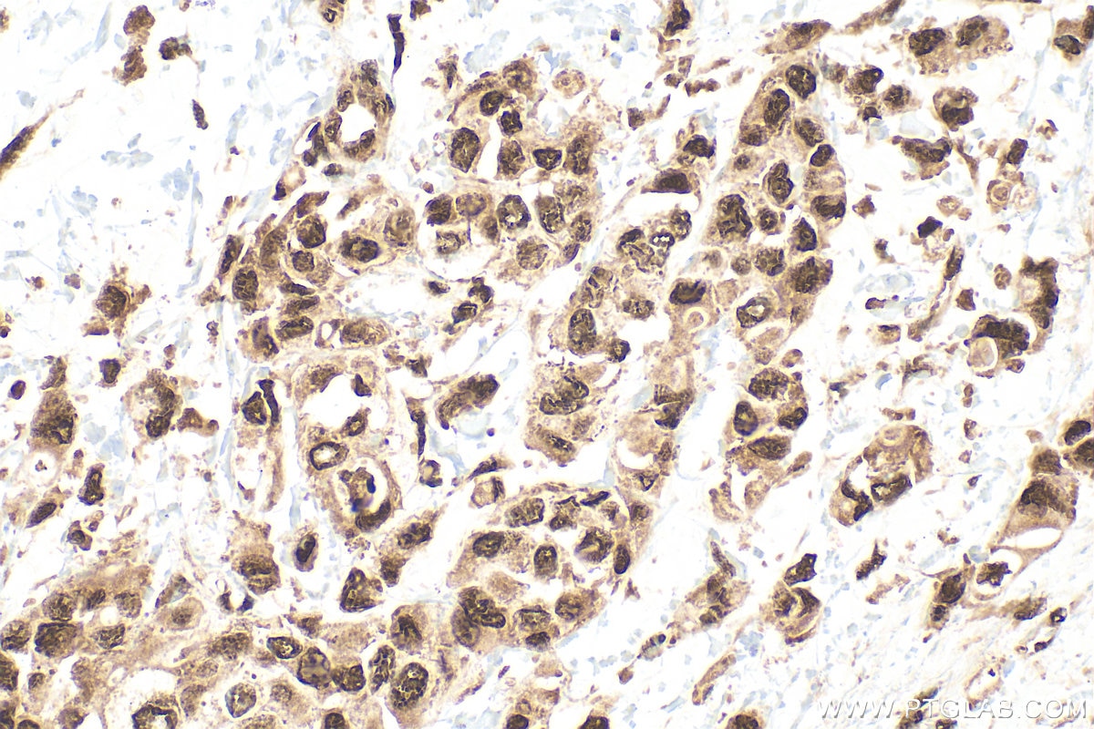 IHC staining of human breast cancer using 10829-1-AP Immunohistochemistry (IHC) staining of human breast cancer tissue using HMGB1 Polyclonal antibody (10829-1-AP)