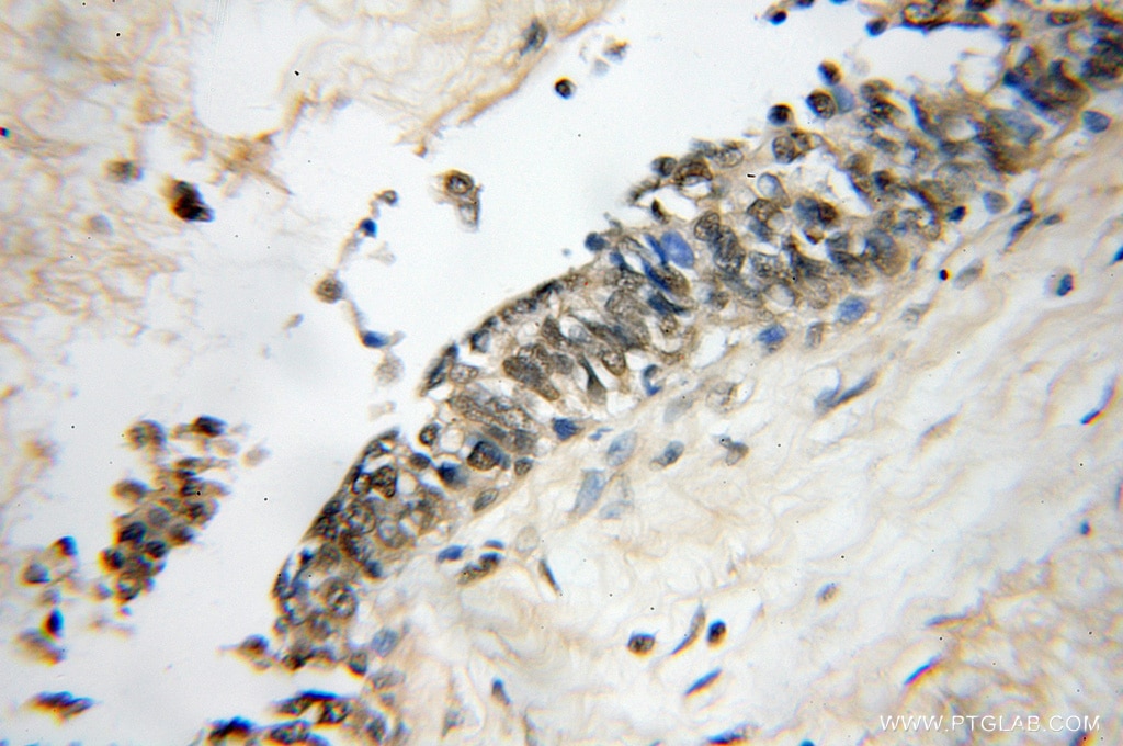 IHC staining of human breast cancer using 10829-1-AP