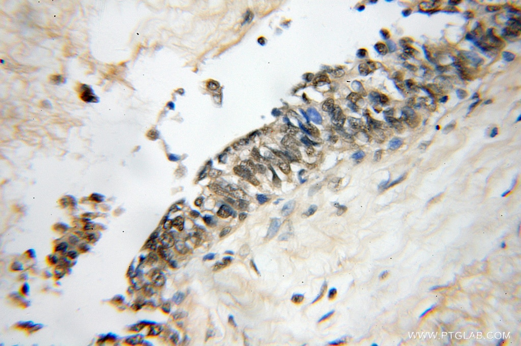 Immunohistochemistry (IHC) staining of human breast cancer tissue using HMGB1 Polyclonal antibody (10829-1-AP)