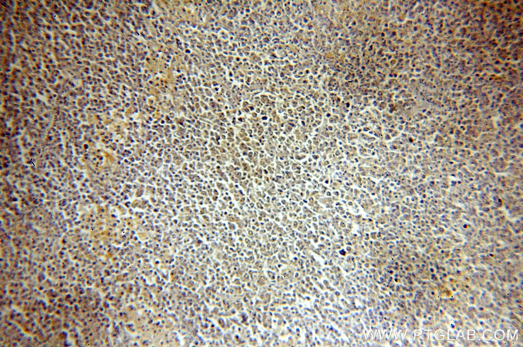 IHC staining of human lymphoma using 15605-1-AP