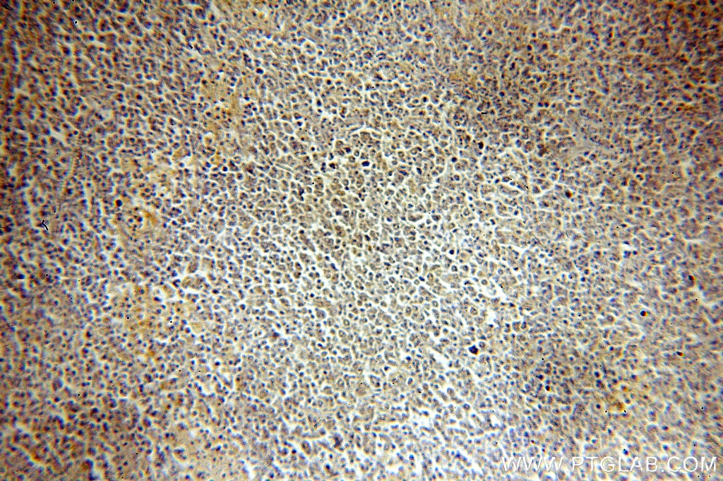 Immunohistochemistry (IHC) staining of human lymphoma tissue using HMGB2 Polyclonal antibody (15605-1-AP)