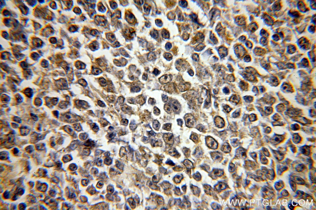 Immunohistochemistry (IHC) staining of human lymphoma tissue using HMGB2 Polyclonal antibody (15605-1-AP)