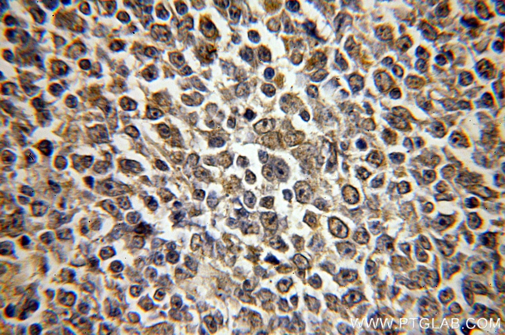 Immunohistochemistry (IHC) staining of human lymphoma tissue using HMGB2 Polyclonal antibody (15605-1-AP)