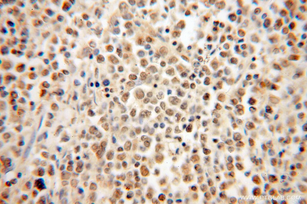 Immunohistochemistry (IHC) staining of human lymphoma tissue using HMGB2 Polyclonal antibody (15605-1-AP)