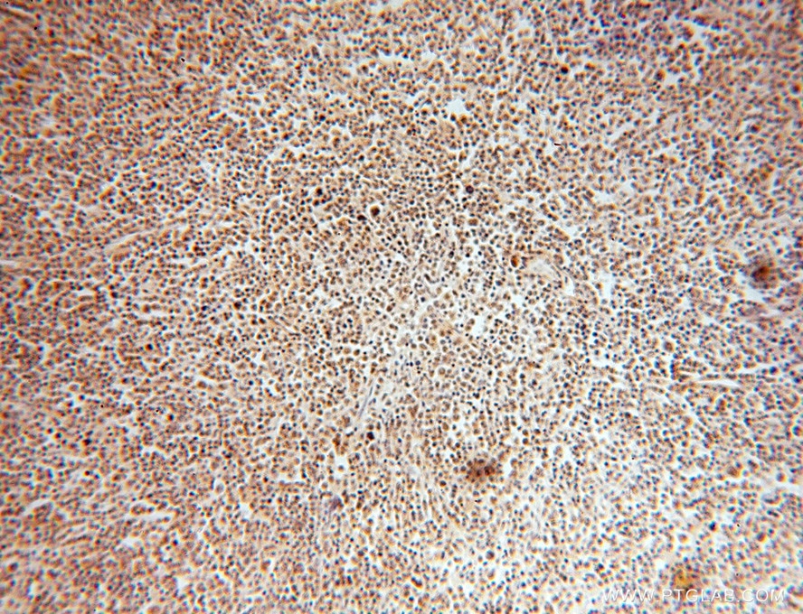 IHC staining of human lymphoma using 15605-1-AP