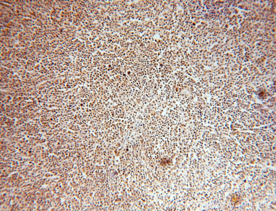 Immunohistochemistry (IHC) staining of human lymphoma tissue using HMGB2 Polyclonal antibody (15605-1-AP)