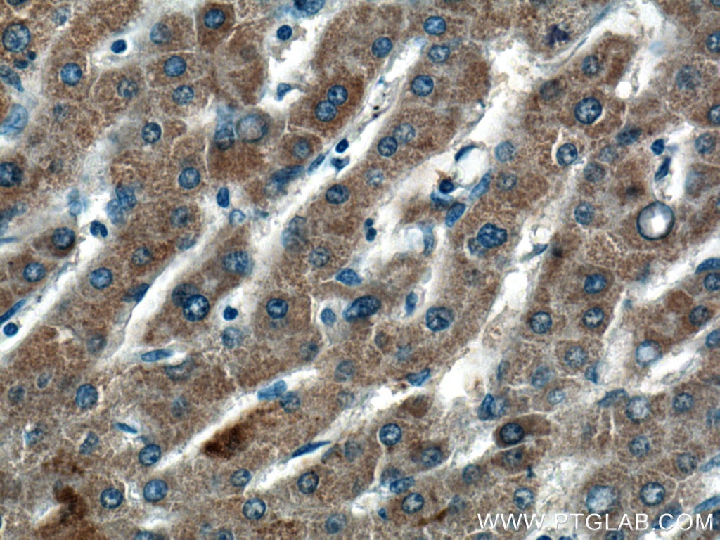 Immunohistochemistry (IHC) staining of human liver cancer tissue using HMGCLL1 Polyclonal antibody (17206-1-AP)