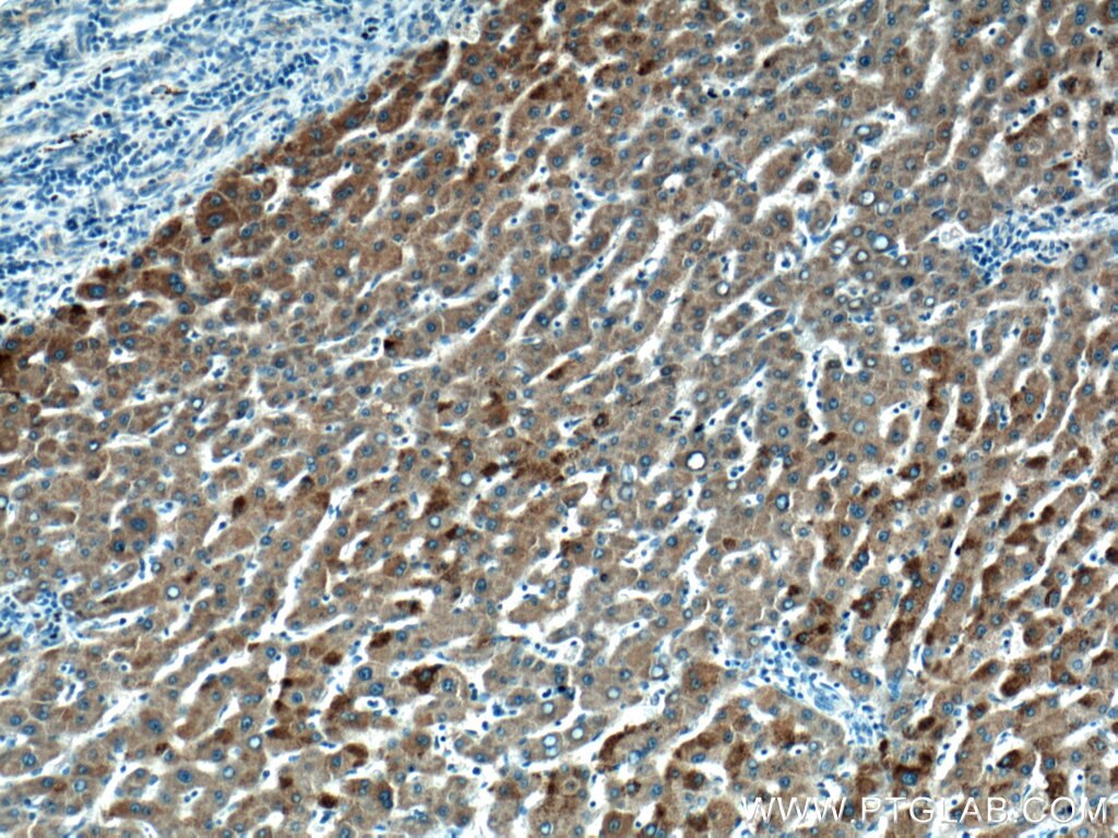 Immunohistochemistry (IHC) staining of human liver cancer tissue using HMGCLL1 Polyclonal antibody (17206-1-AP)