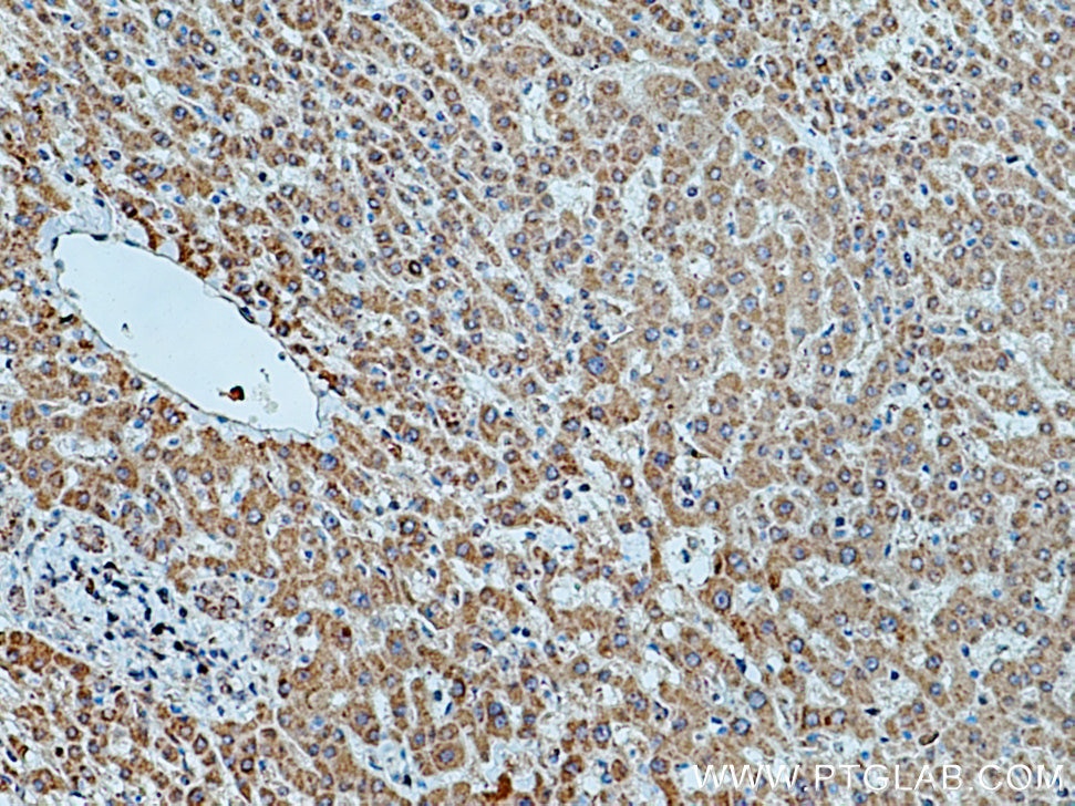 Immunohistochemistry (IHC) staining of human liver cancer tissue using HMGCR Polyclonal antibody (13533-1-AP)