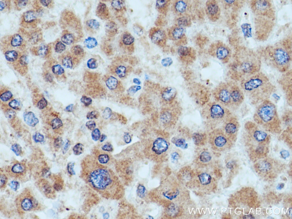Immunohistochemistry (IHC) staining of human liver cancer tissue using HMGCR Polyclonal antibody (13533-1-AP)