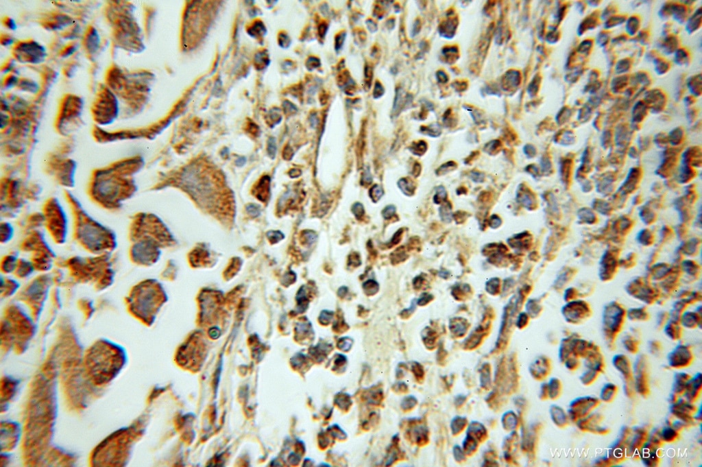 Immunohistochemistry (IHC) staining of human prostate cancer tissue using HMGN2 Polyclonal antibody (10953-1-AP)