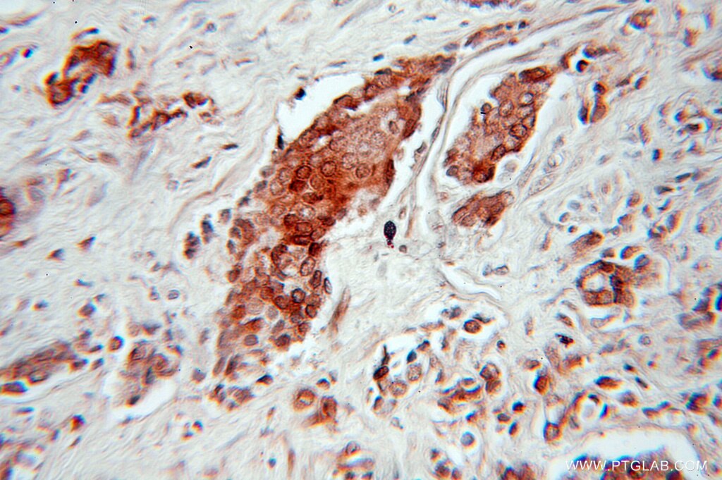 Immunohistochemistry (IHC) staining of human prostate cancer tissue using HMGN2 Polyclonal antibody (10953-1-AP)