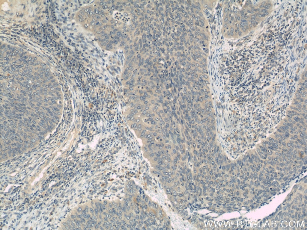 Immunohistochemistry (IHC) staining of human cervical cancer tissue using HMGN2 Polyclonal antibody (10953-1-AP)