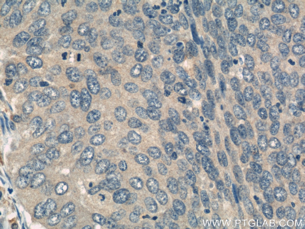 Immunohistochemistry (IHC) staining of human cervical cancer tissue using HMGN2 Polyclonal antibody (10953-1-AP)