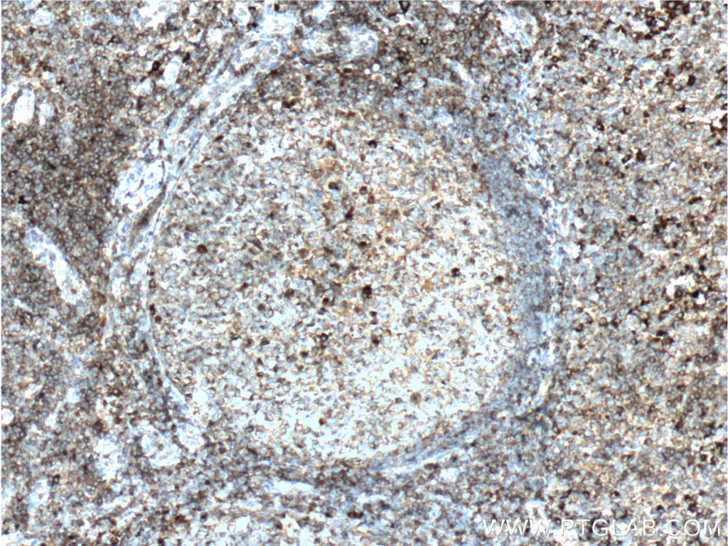 Immunohistochemistry (IHC) staining of human tonsillitis tissue using HMMR-Specific Polyclonal antibody (15820-1-AP)