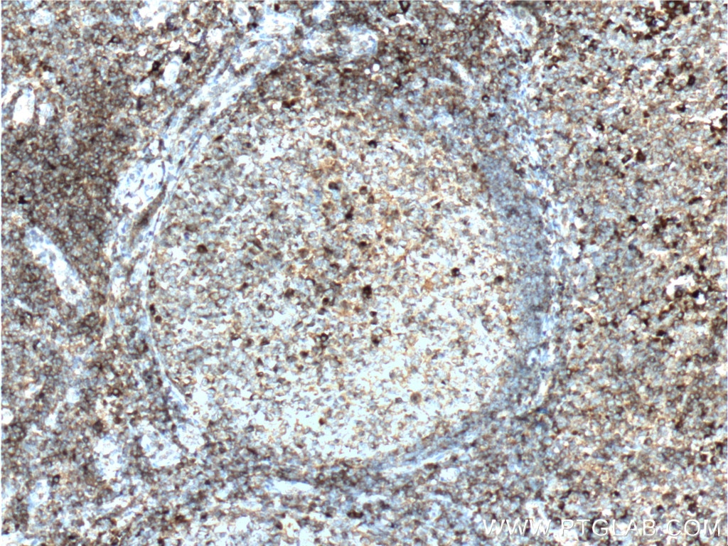 IHC staining of human tonsillitis using 15820-1-AP