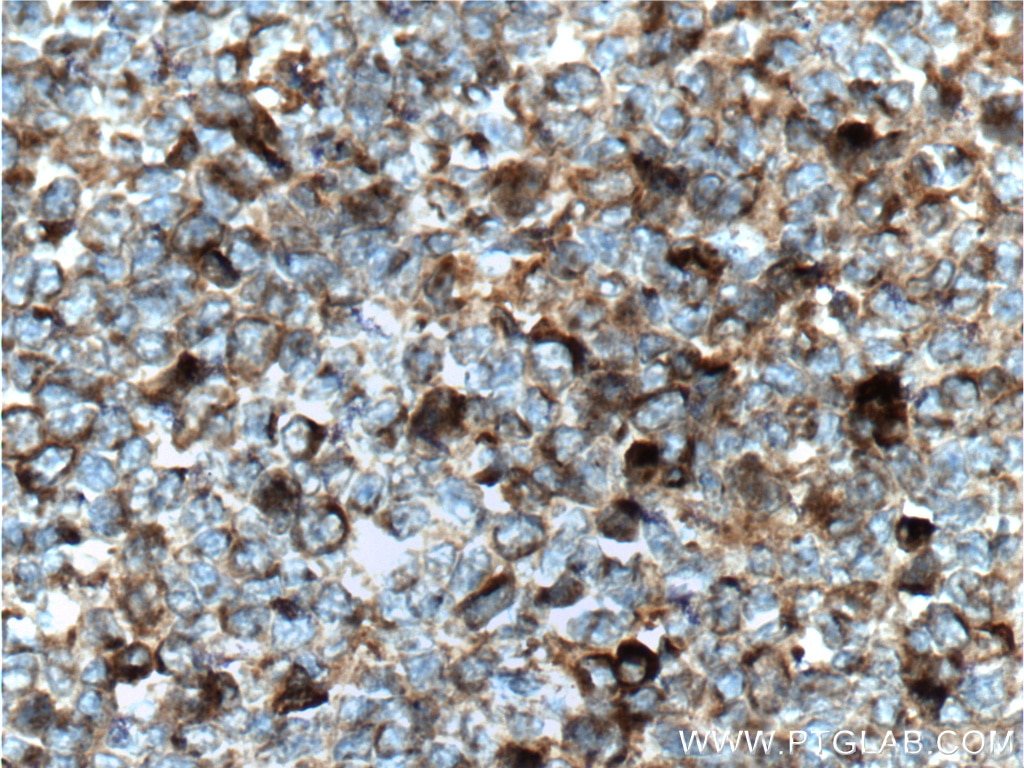 Immunohistochemistry (IHC) staining of human tonsillitis tissue using HMMR-Specific Polyclonal antibody (15820-1-AP)