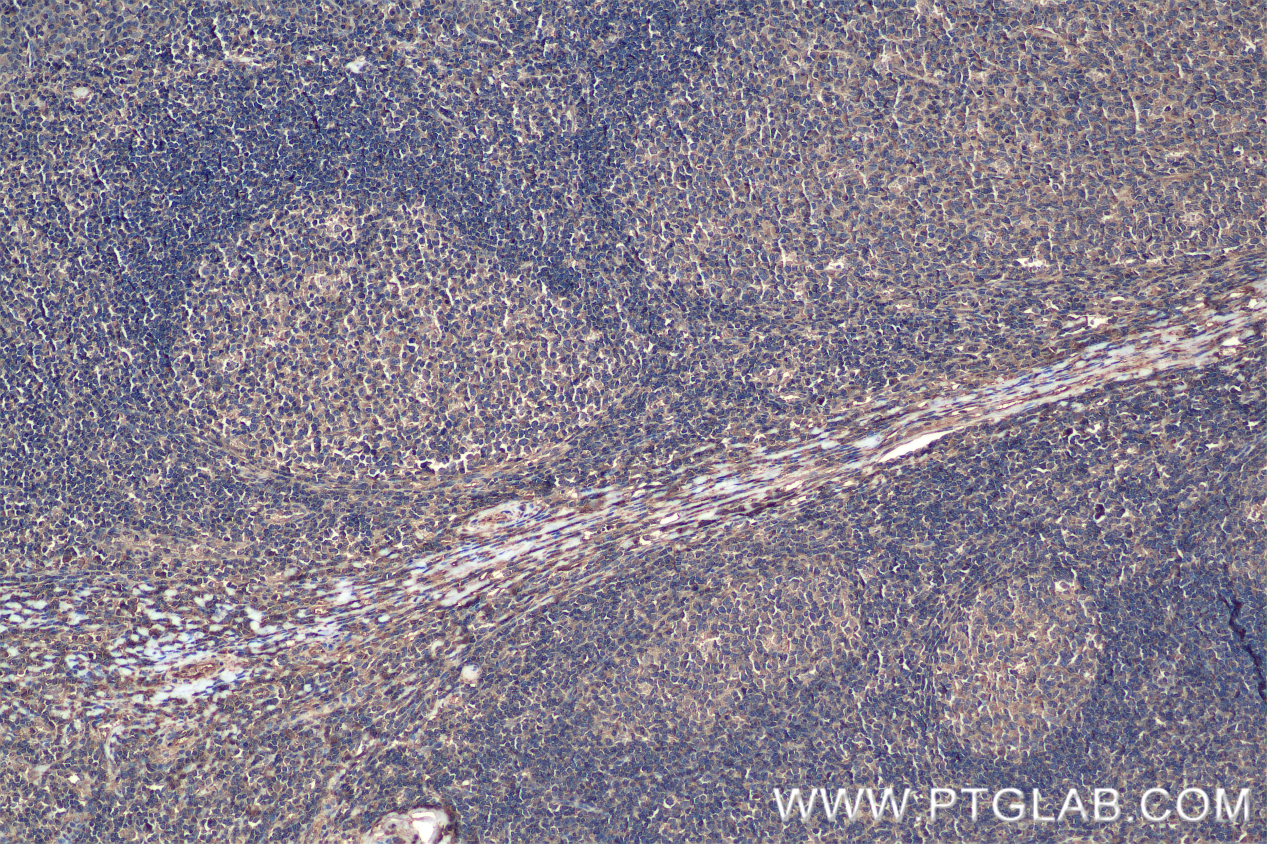 Immunohistochemistry (IHC) staining of human tonsillitis tissue using HMMR-Specific Recombinant antibody (85094-1-RR)