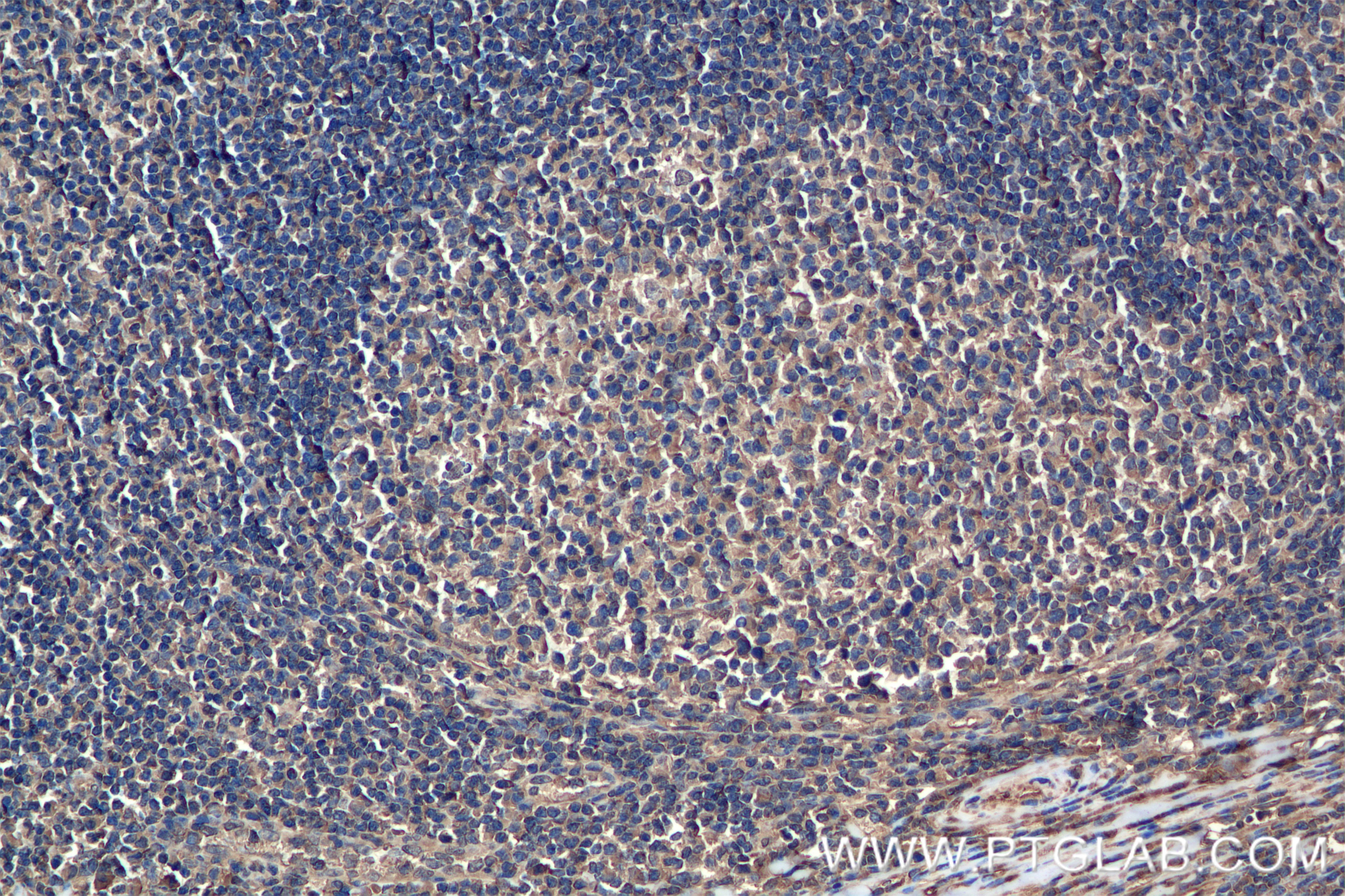 Immunohistochemistry (IHC) staining of human tonsillitis tissue using HMMR-Specific Recombinant antibody (85094-1-RR)