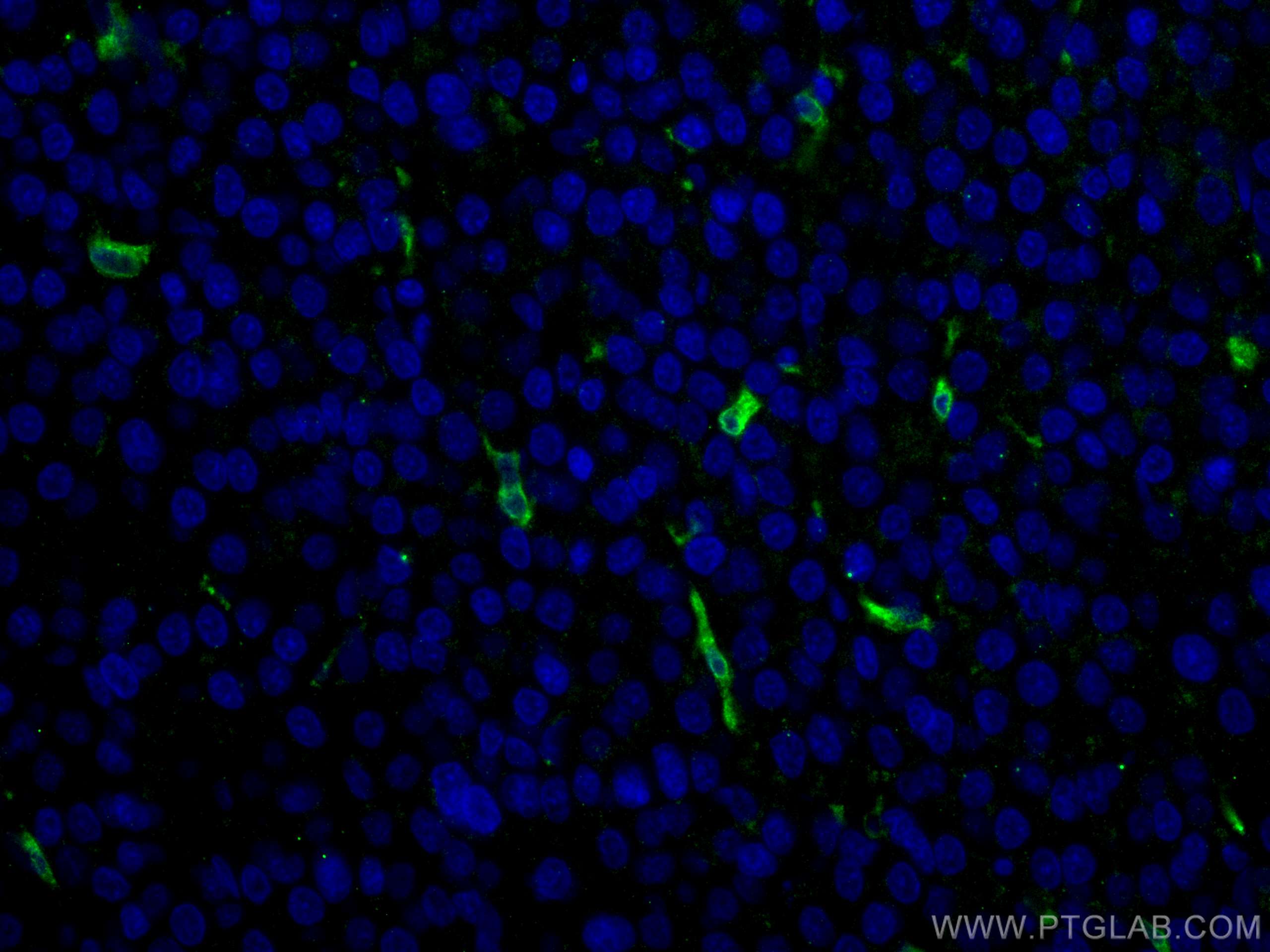 Immunofluorescence (IF) / fluorescent staining of human liver cancer tissue using HO-1/HMOX1 Polyclonal antibody (10701-1-AP)