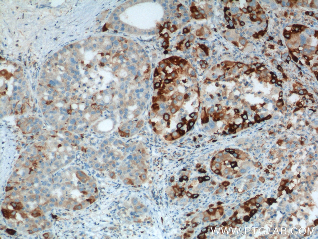 IHC staining of human liver cancer using 10701-1-AP