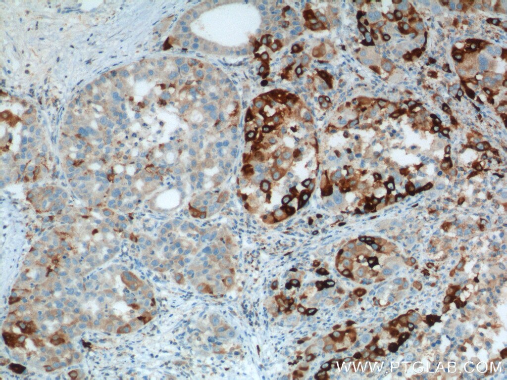 Immunohistochemistry (IHC) staining of human liver cancer tissue using HO-1/HMOX1 Polyclonal antibody (10701-1-AP)