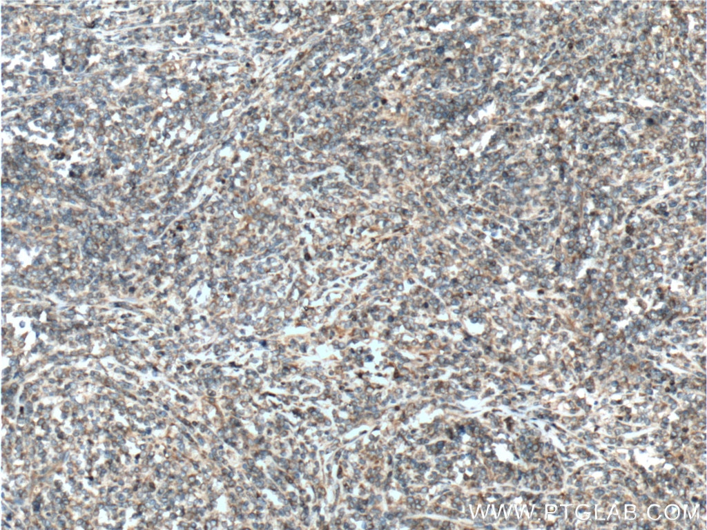 Immunohistochemistry (IHC) staining of human lymphoma tissue using HMOX2 Polyclonal antibody (14817-1-AP)