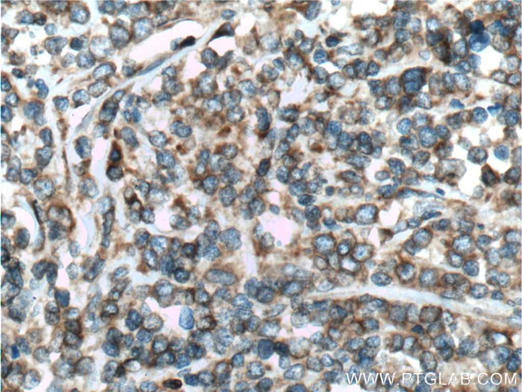 Immunohistochemistry (IHC) staining of human lymphoma tissue using HMOX2 Polyclonal antibody (14817-1-AP)