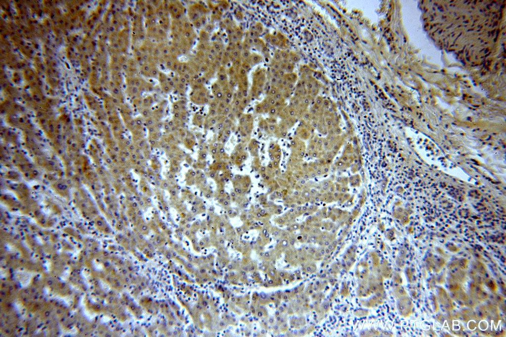 Immunohistochemistry (IHC) staining of human hepatocirrhosis tissue using HMP19 Polyclonal antibody (19423-1-AP)