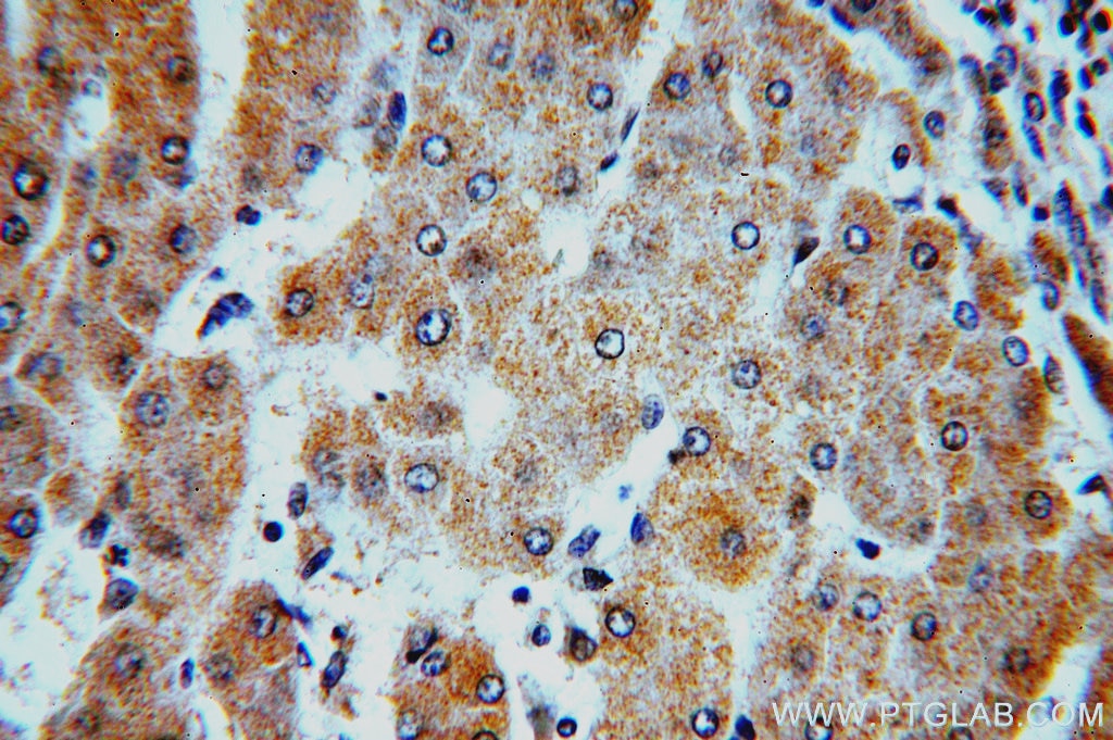 Immunohistochemistry (IHC) staining of human hepatocirrhosis tissue using HMP19 Polyclonal antibody (19423-1-AP)