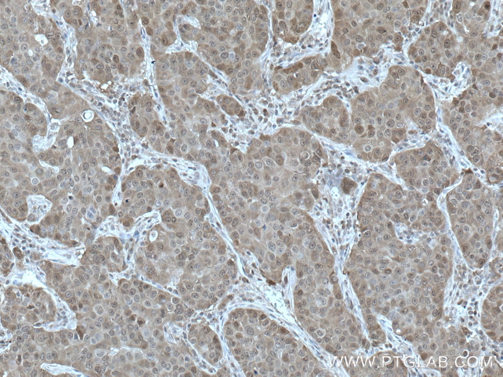 Immunohistochemistry (IHC) staining of human breast cancer tissue using HN1 Polyclonal antibody (14914-1-AP)