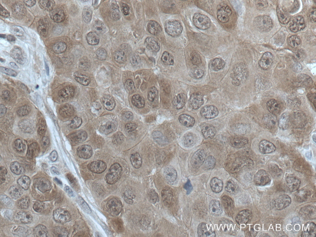 Immunohistochemistry (IHC) staining of human breast cancer tissue using HN1 Polyclonal antibody (14914-1-AP)