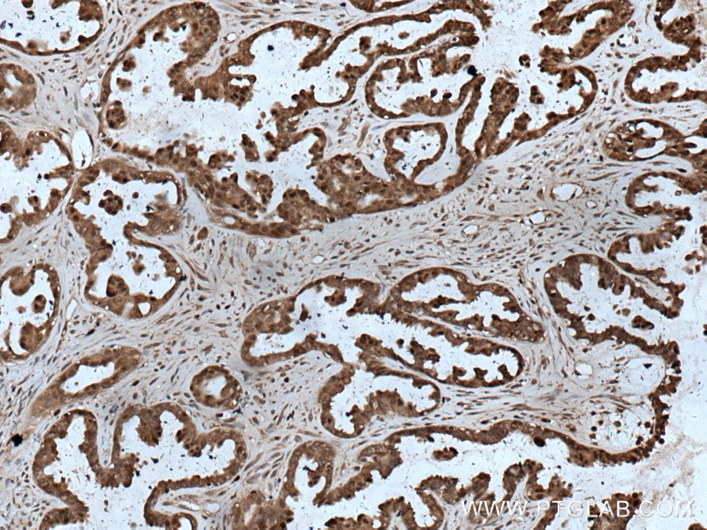 Immunohistochemistry (IHC) staining of human ovary tumor tissue using HN1 Polyclonal antibody (14914-1-AP)