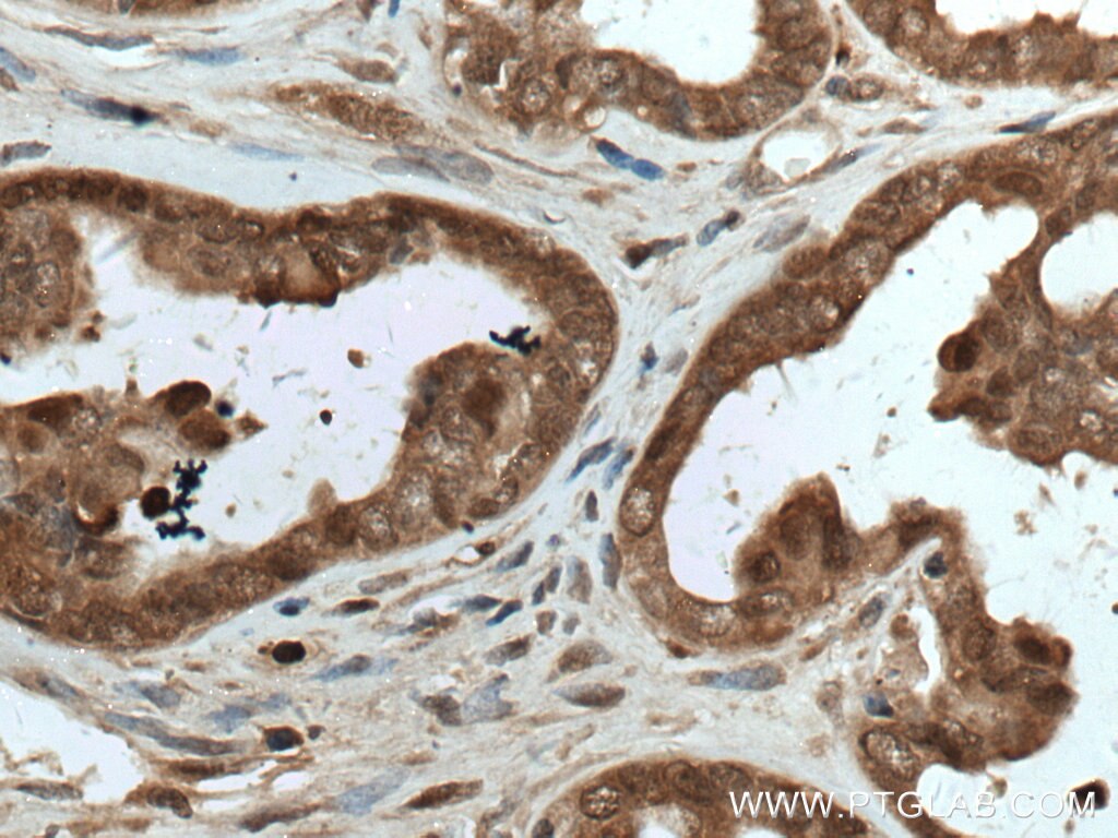 Immunohistochemistry (IHC) staining of human ovary tumor tissue using HN1 Polyclonal antibody (14914-1-AP)