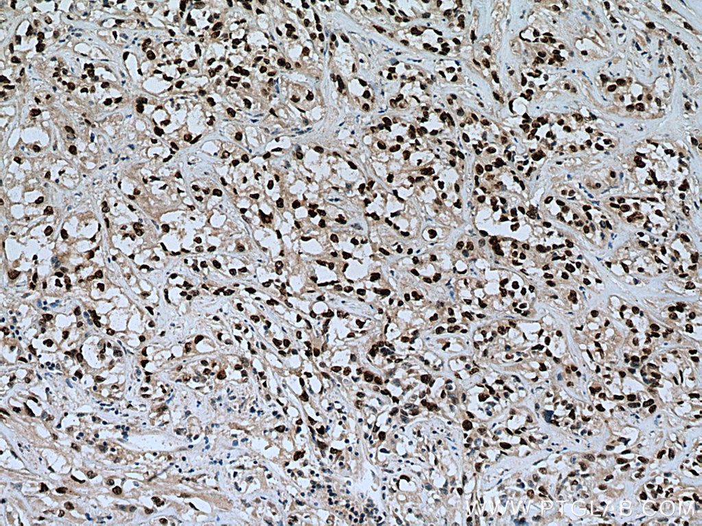 Immunohistochemistry (IHC) staining of human renal cell carcinoma tissue using HNF1B Polyclonal antibody (12533-1-AP)